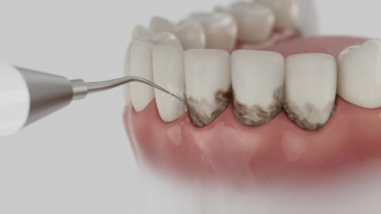 Trusted Wisdom Tooth Removal service in Granby, CO - Dentist Open Now